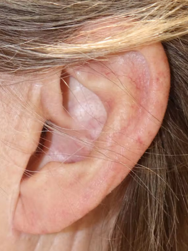 Earlobe Repair Before & After Gallery - Patient 123127694 - Image 2