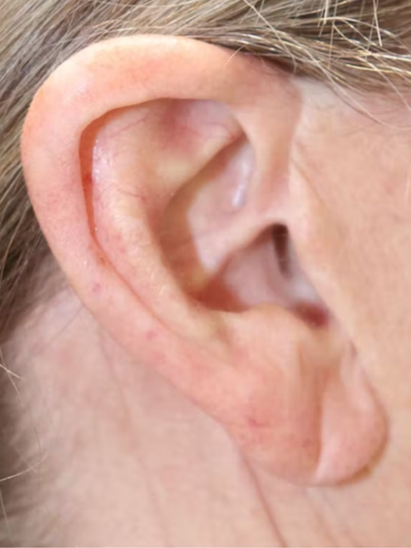 Earlobe Repair Before & After Gallery - Patient 123127694 - Image 3