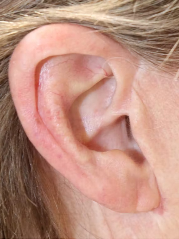 Earlobe Repair Before & After Gallery - Patient 123127694 - Image 4