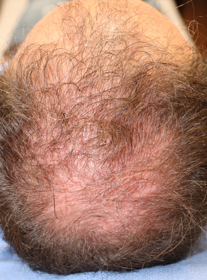 Hair Restoration with Exosomes Before & After Gallery - Patient 37796886 - Image 5