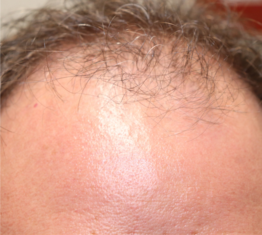 Hair Restoration with Exosomes Before & After Gallery - Patient 37796886 - Image 7