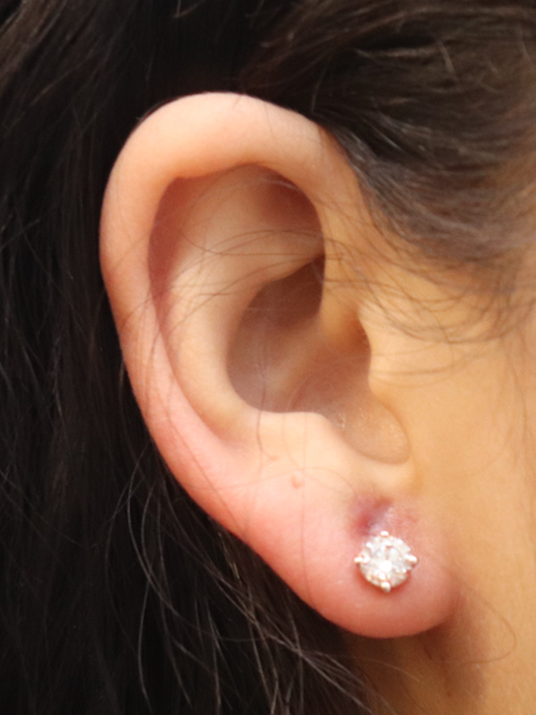 Earlobe Repair Before & After Gallery - Patient 145354777 - Image 2