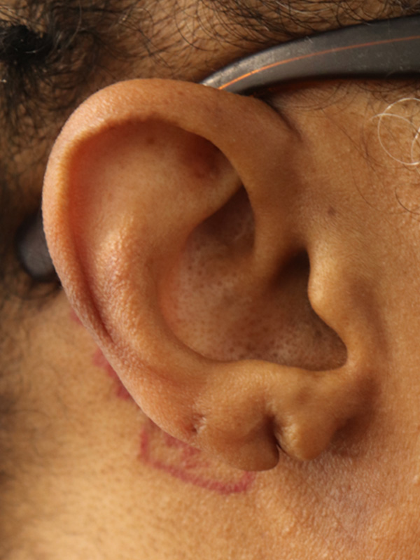 Earlobe Repair Before & After Gallery - Patient 145354785 - Image 1