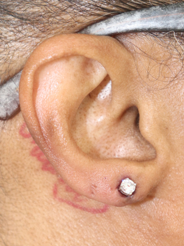 Earlobe Repair Before & After Gallery - Patient 145354785 - Image 2