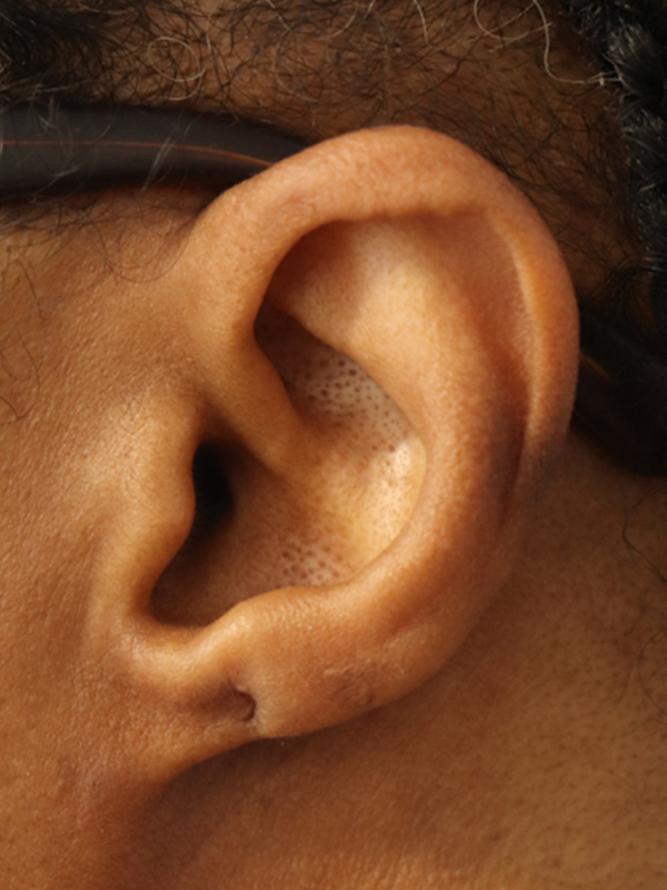 Earlobe Repair Before & After Gallery - Patient 145354785 - Image 3