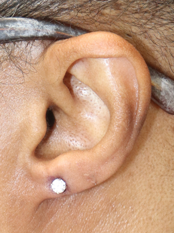 Earlobe Repair Before & After Gallery - Patient 145354785 - Image 4