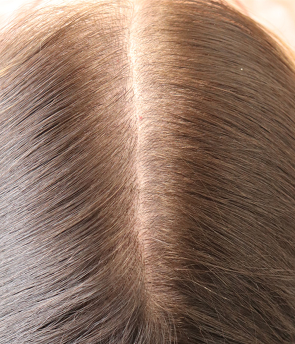 Hair Restoration with Exosomes Before & After Gallery - Patient 145355007 - Image 4