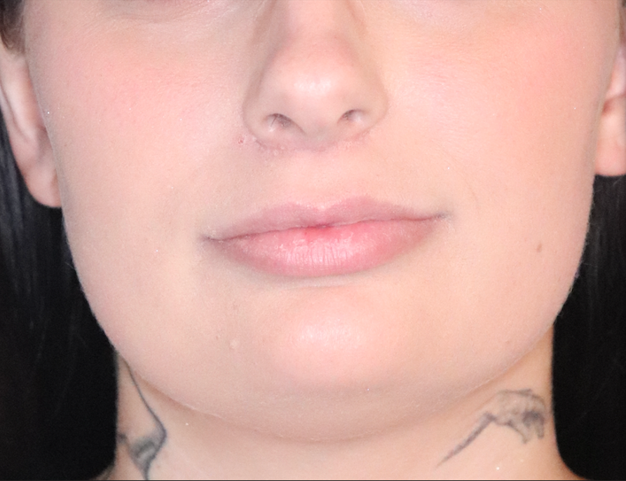 Lip Filler Before & After Gallery - Patient 145354906 - Image 1