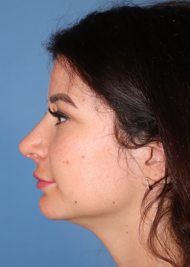 Exosome Facial Before & After Gallery - Patient 145355001 - Image 3