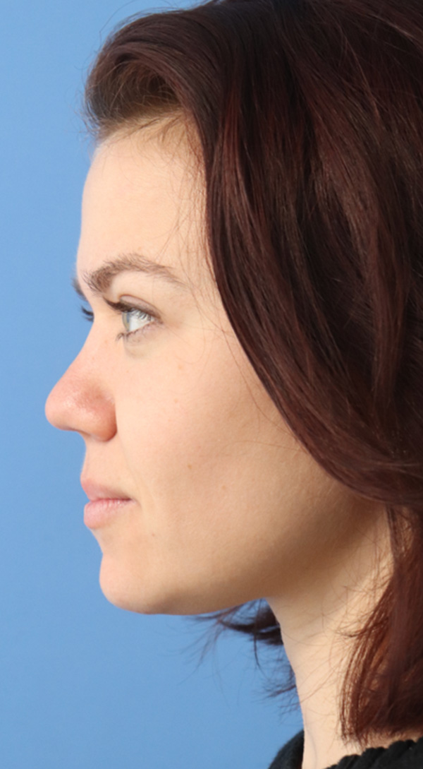 Rhinoplasty Before & After Gallery - Patient 120346808 - Image 4