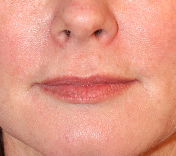 Lip Filler Before & After Gallery - Patient 144976905 - Image 2