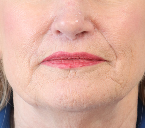 Lip Lift Before & After Gallery - Patient 148828613 - Image 2