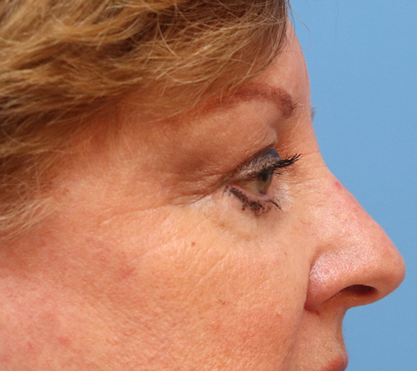 Mole Removal Before & After Gallery - Patient 32769518 - Image 2