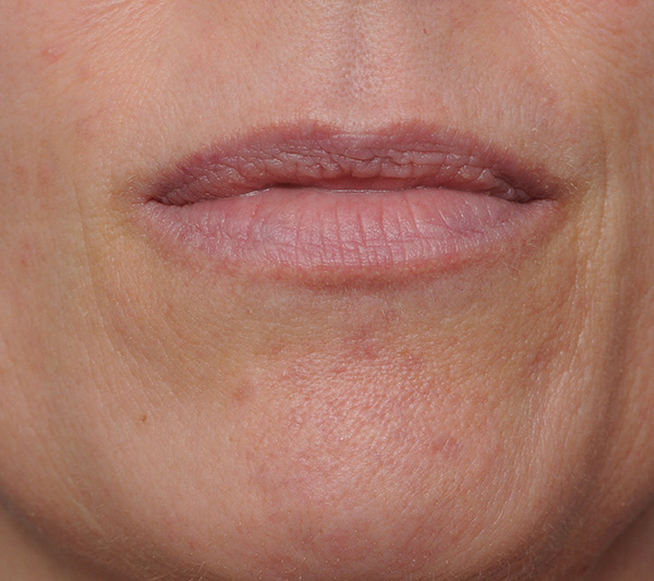 Mole Removal Before & After Gallery - Patient 8647154 - Image 2