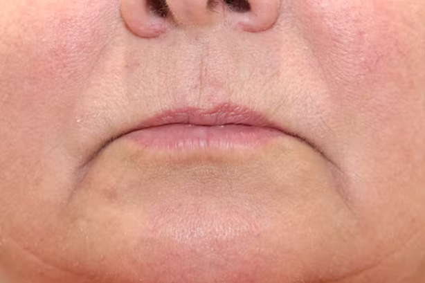 Lip Filler Before & After Gallery - Patient 149296908 - Image 1