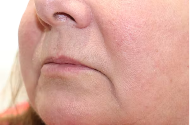 Lip Filler Before & After Gallery - Patient 149296908 - Image 3