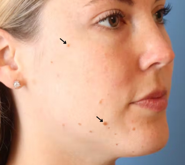 Mole Removal Before & After Gallery - Patient 145354857 - Image 1