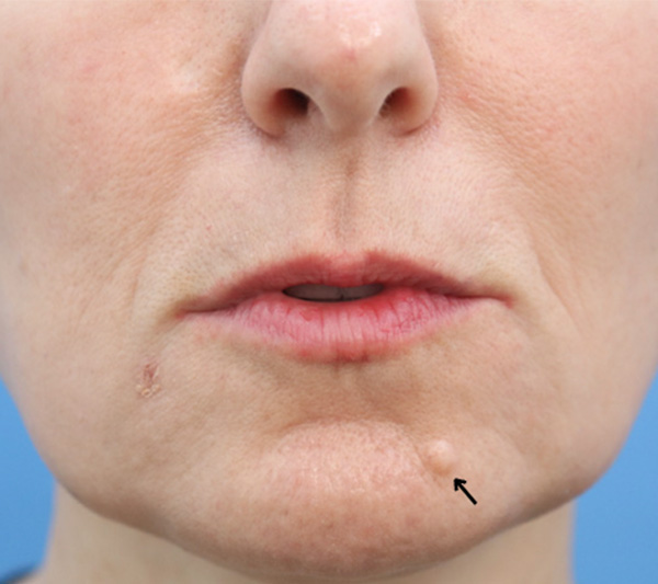 Mole Removal Before & After Gallery - Patient 148828615 - Image 1