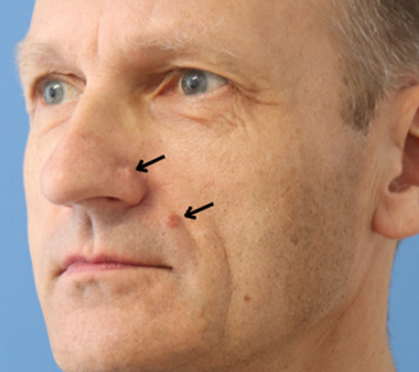 Mole Removal Before & After Gallery - Patient 149297292 - Image 3