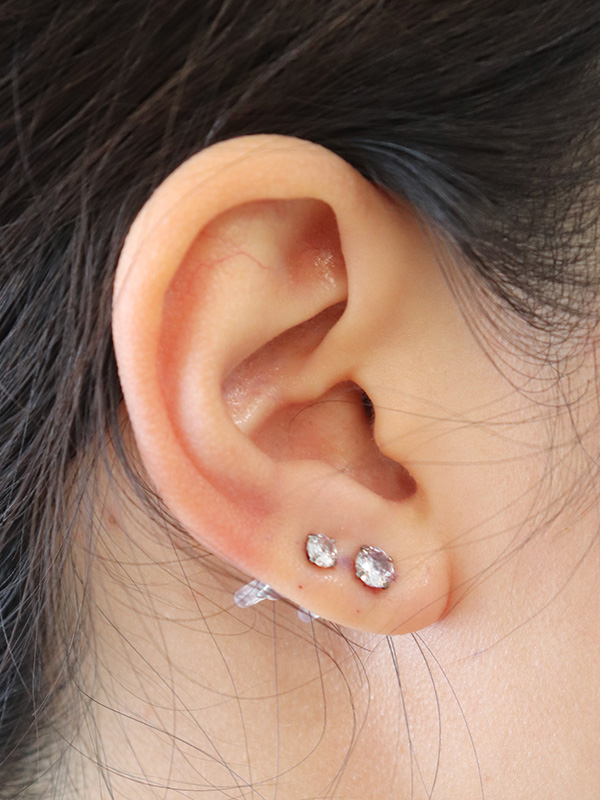 Earlobe Repair Before & After Gallery - Patient 152434076 - Image 2