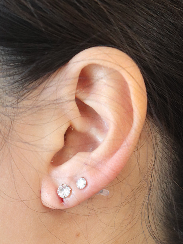 Earlobe Repair Before & After Gallery - Patient 152434076 - Image 4