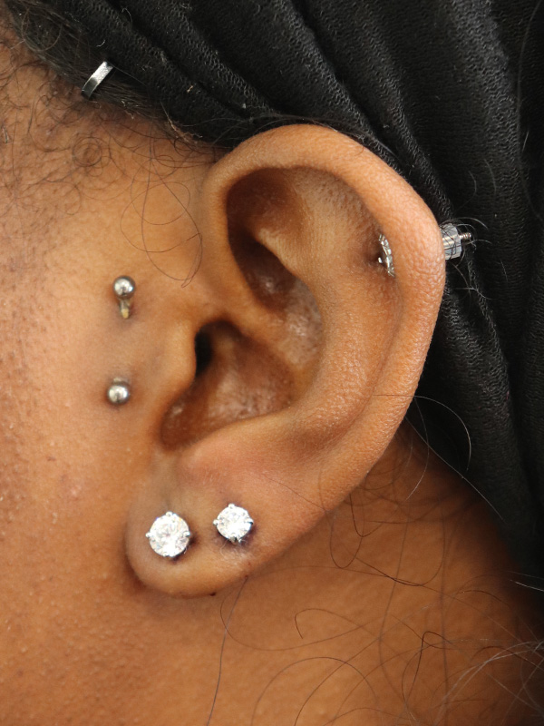 Earlobe Repair Before & After Gallery - Patient 152434075 - Image 4