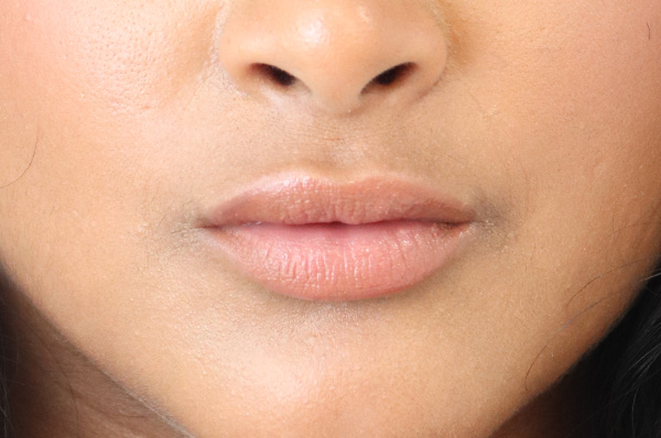 Lip Filler Before & After Gallery - Patient 152434080 - Image 2