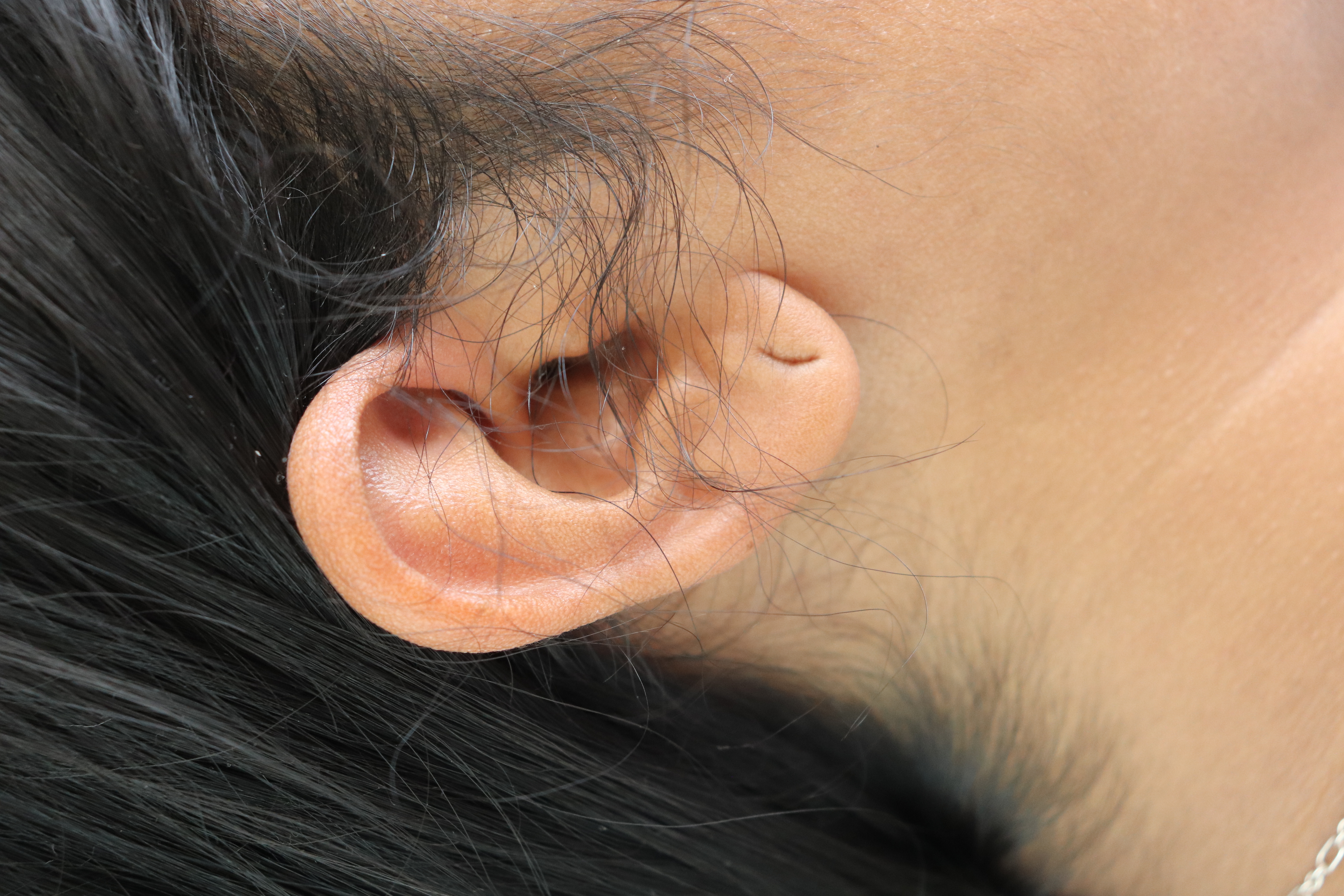 Earlobe Repair Before & After Gallery - Patient 346832 - Image 1