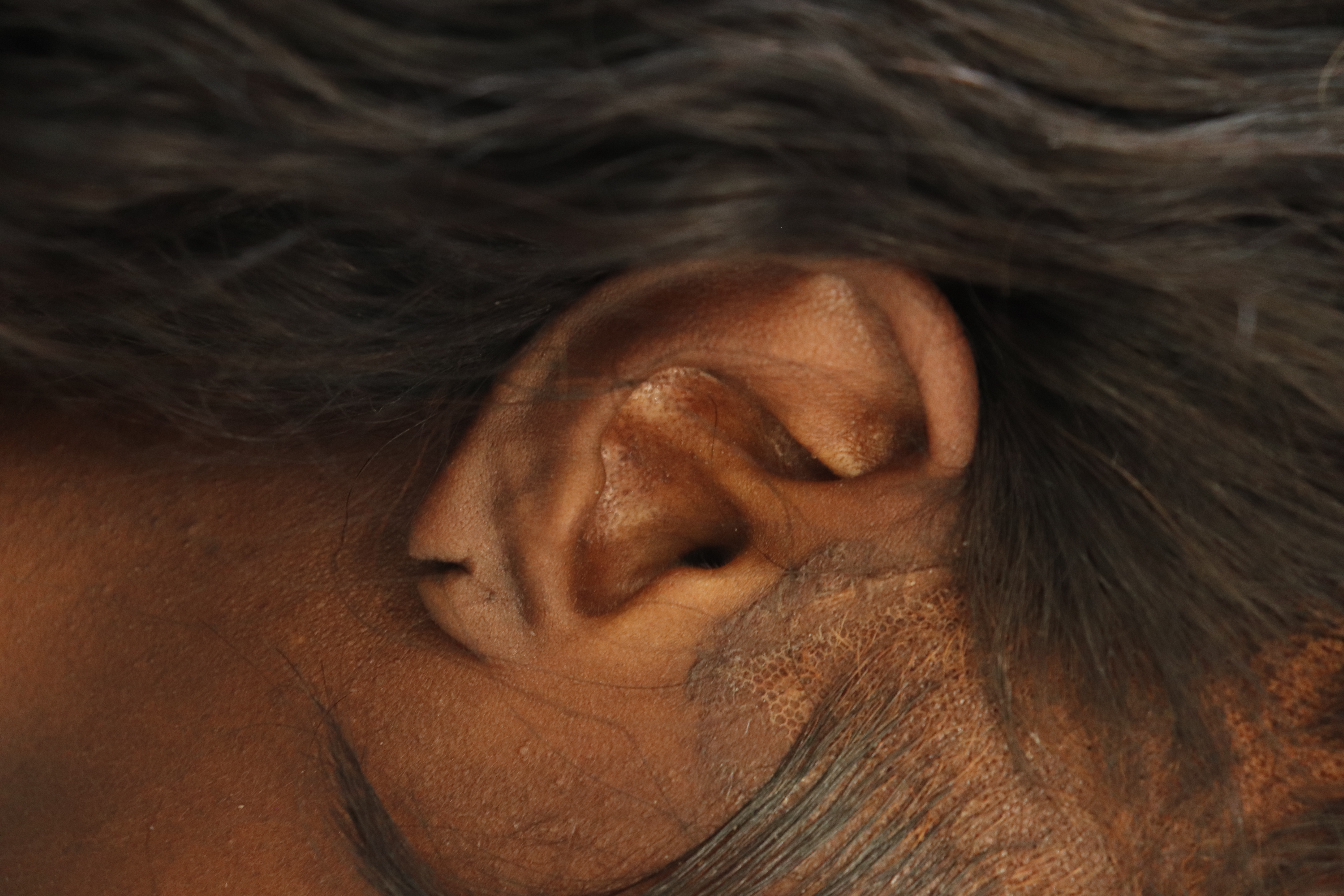 Earlobe Repair Before & After Gallery - Patient 378428 - Image 1