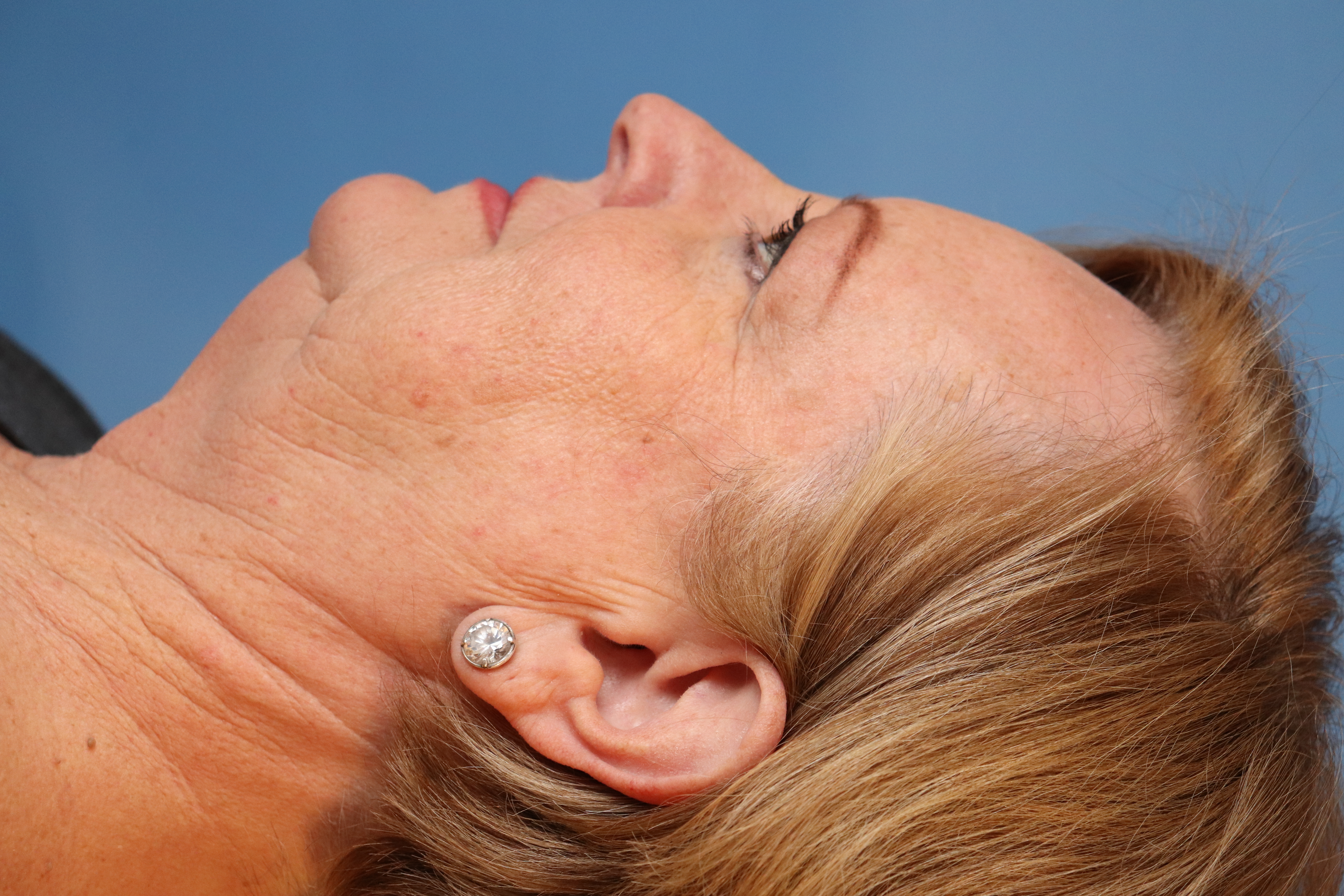 Facelift Before & After Gallery - Patient 886458 - Image 1