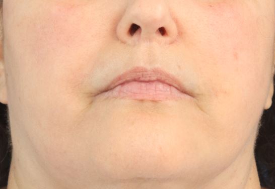 Lip Filler Before & After Gallery - Patient 174494 - Image 1