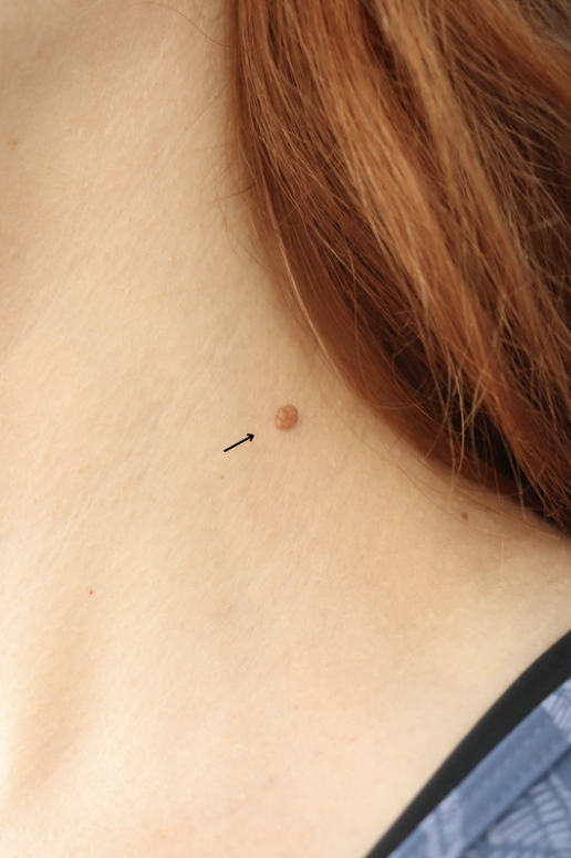 Mole Removal Before & After Gallery - Patient 273471 - Image 1