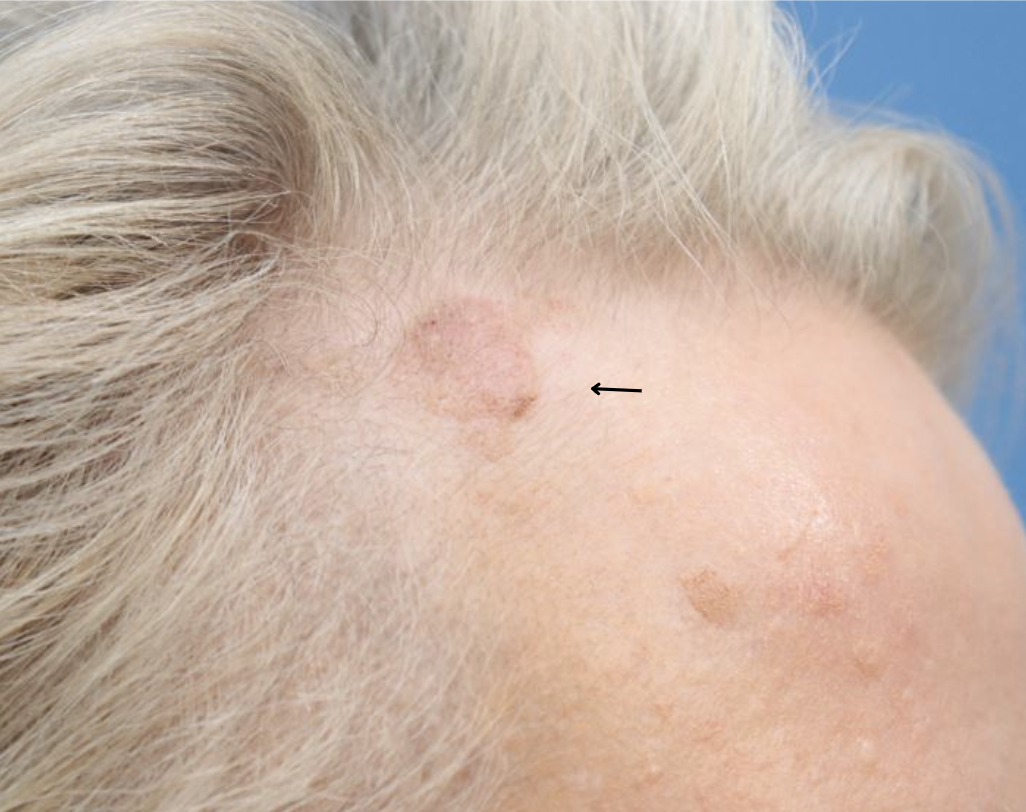 Mole Removal Before & After Gallery - Patient 182882 - Image 1