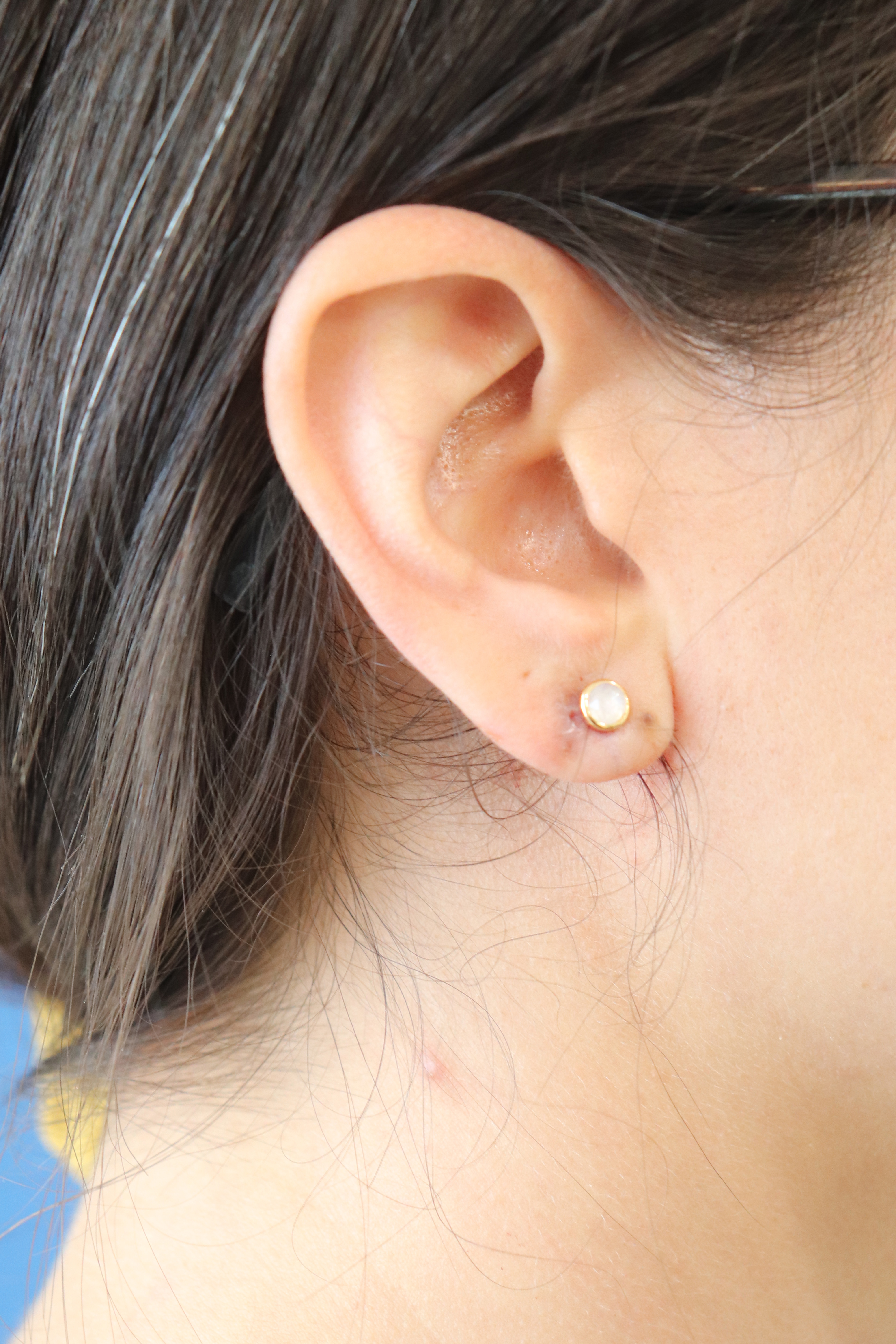 Earlobe Repair Before & After Gallery - Patient 203854 - Image 2