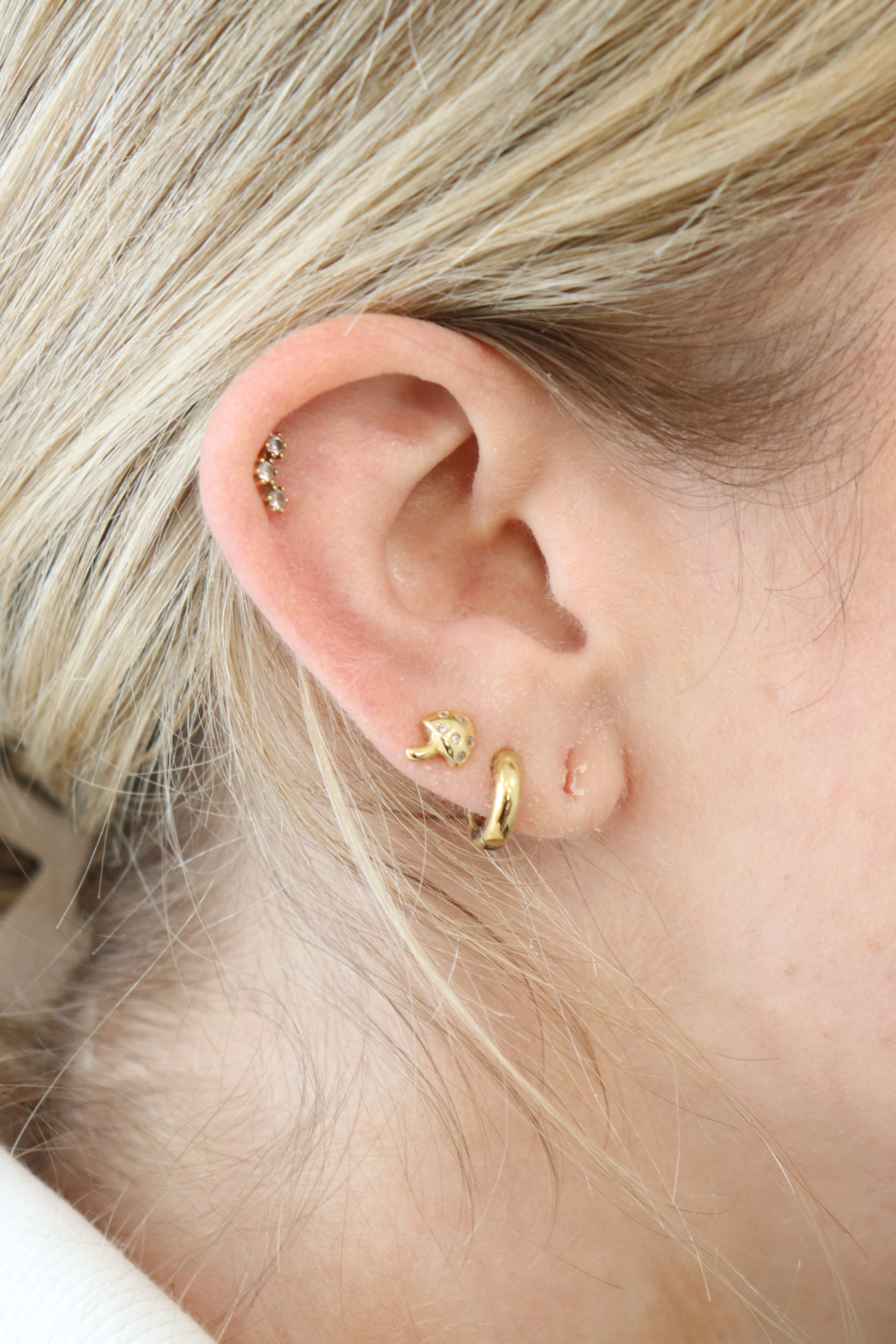 Earlobe Repair Before & After Gallery - Patient 291521 - Image 1