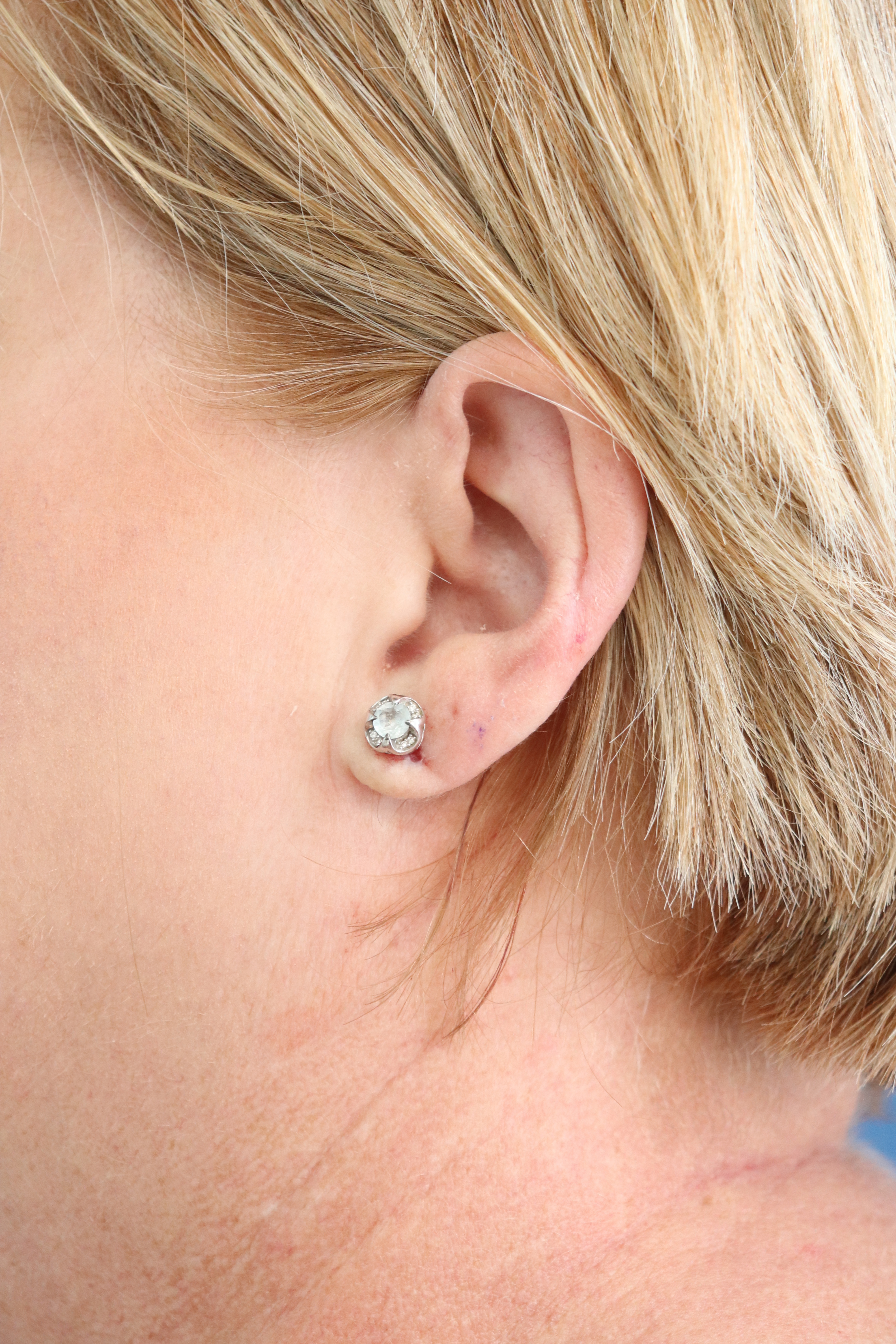 Earlobe Repair Before & After Gallery - Patient 373343 - Image 2