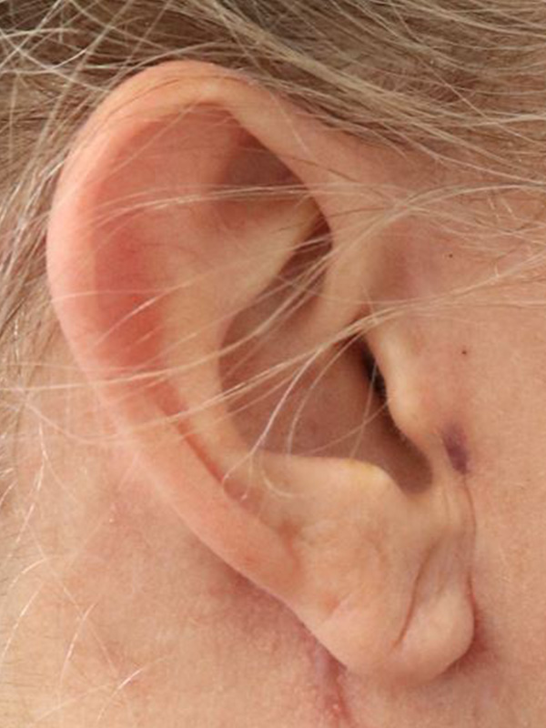 Earlobe Repair Before & After Gallery - Patient 243766 - Image 1