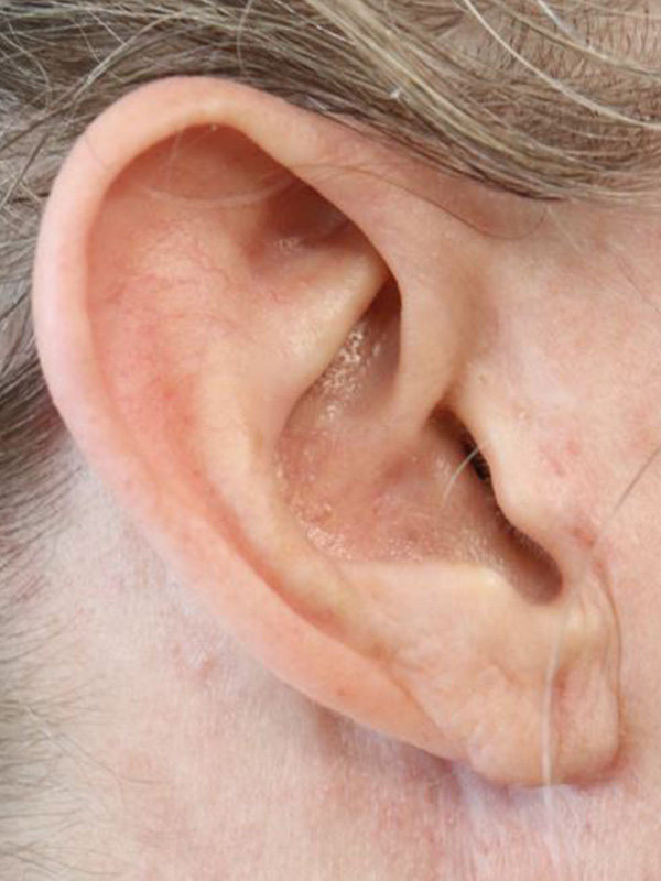 Earlobe Repair Before & After Gallery - Patient 243766 - Image 2