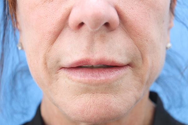 Lip Filler Before & After Gallery - Patient 912540 - Image 1