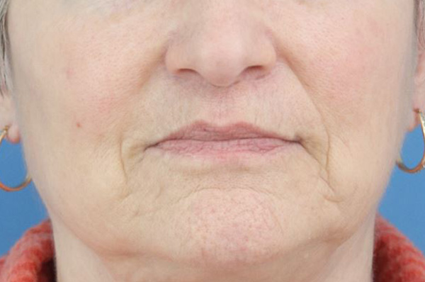 Lip Lift Before & After Gallery - Patient 316053 - Image 2