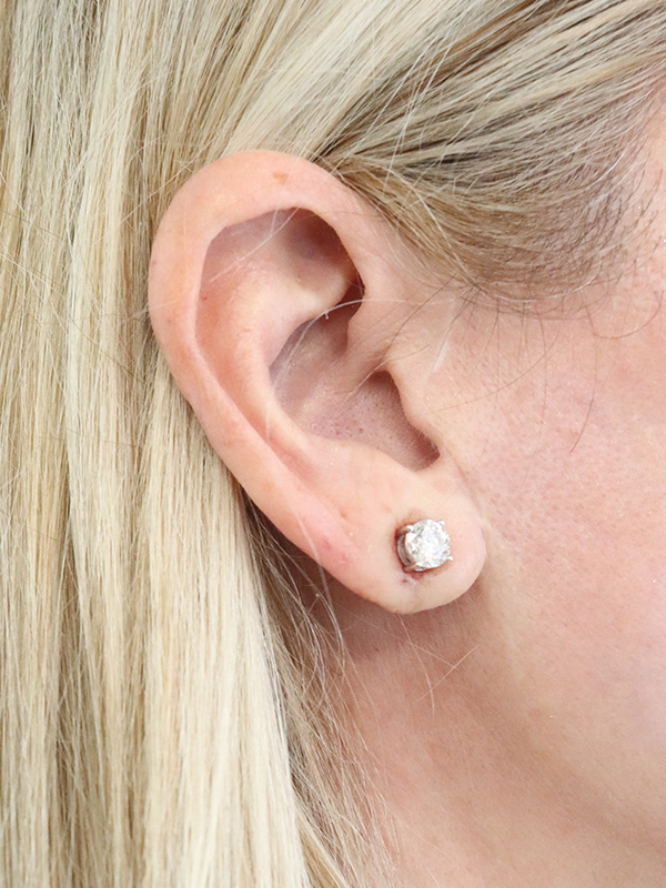 Earlobe Repair Before & After Gallery - Patient 346269 - Image 2