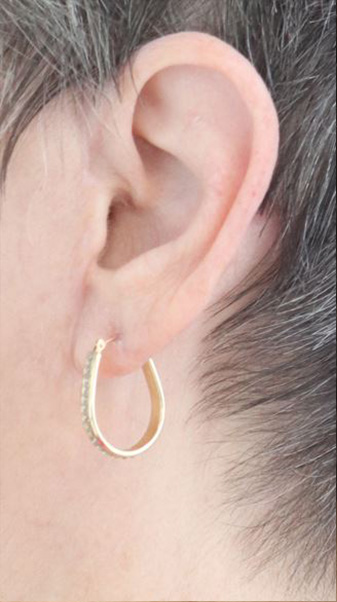 Earlobe Repair Before & After Gallery - Patient 303484 - Image 2