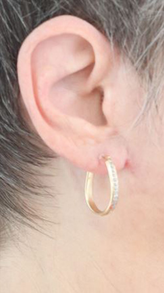 Earlobe Repair Before & After Gallery - Patient 303484 - Image 4