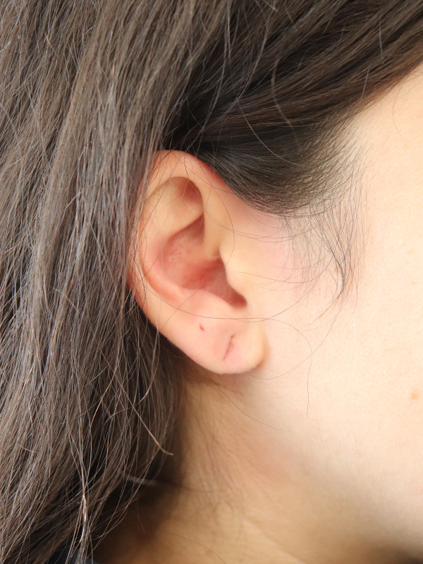 Earlobe Repair Before & After Gallery - Patient 180950 - Image 3