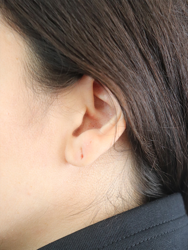 Earlobe Repair Before & After Gallery - Patient 180950 - Image 1