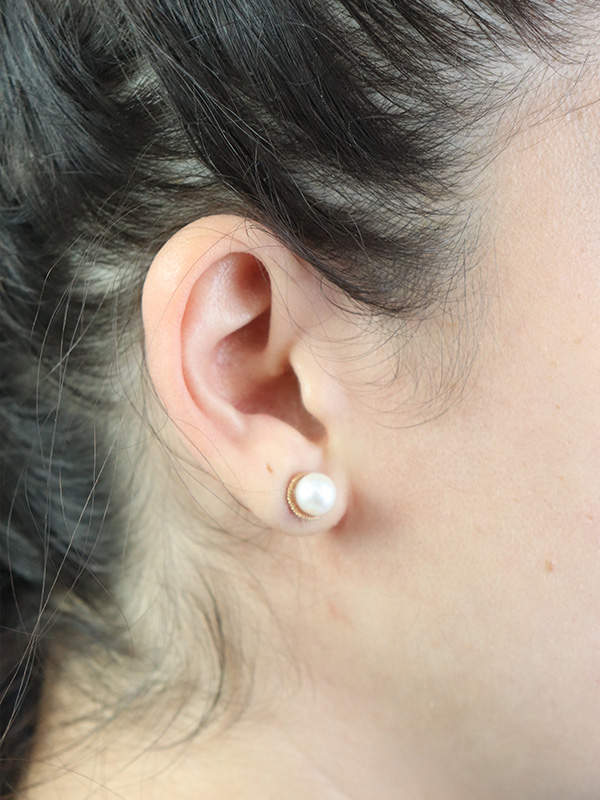 Earlobe Repair Before & After Gallery - Patient 180950 - Image 4