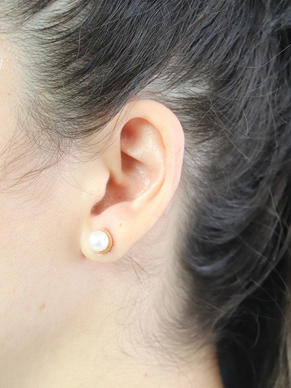 Earlobe Repair Before & After Gallery - Patient 180950 - Image 2