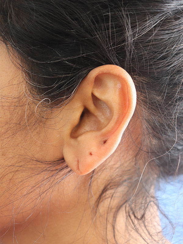 Earlobe Repair Before & After Gallery - Patient 345883 - Image 1