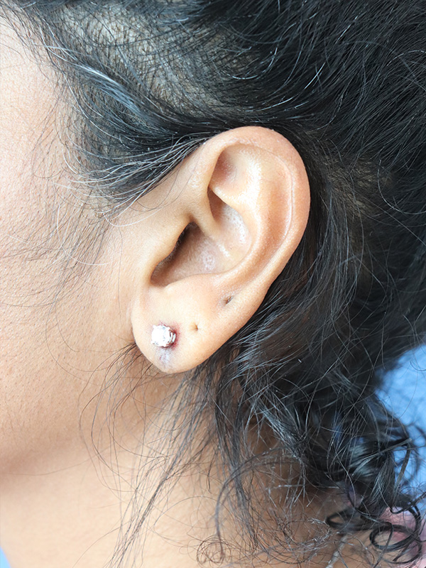 Earlobe Repair Before & After Gallery - Patient 345883 - Image 2