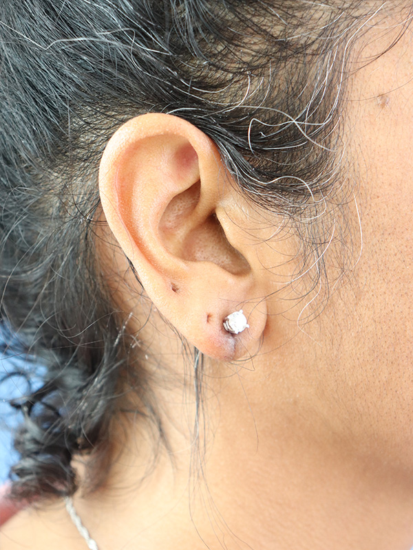 Earlobe Repair Before & After Gallery - Patient 345883 - Image 4